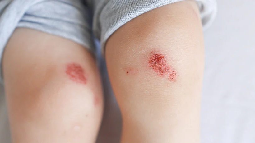 How One Ancient Healing Oil Healed My Wound Naturally — After Weeks of No Progress